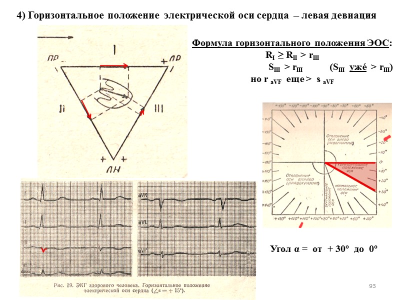 93 4) Горизонтальное положение  электрической оси сердца  – левая девиация Формула горизонтального
